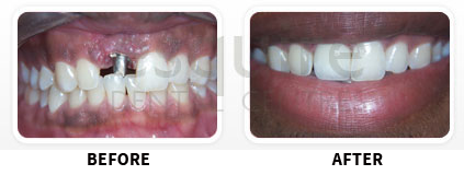 Dental Implants Before After image 01