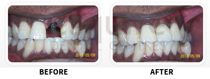 Dental Implants Before After image 06