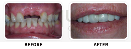 Dental Implants Before After image 08