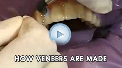 How Veneers Are Made
