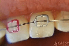 Dentist Chicago Video Gallery - How do Braces Work Video