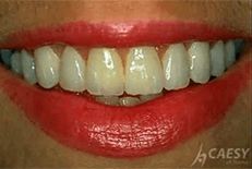Dentist Chicago Video Gallery - How Veneers Are Made Video