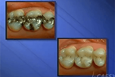 Dentist Chicago Video Gallery - Tooth Colored Fillings Video
