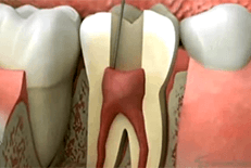 Dentist Chicago Video Gallery - Root Canal Therapy Video