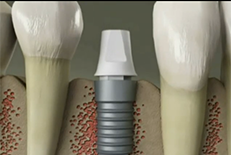 Dentist Chicago Video Gallery - What are Dental Implants Video