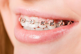 Tooth Braces Chicago - Teeth with Braces