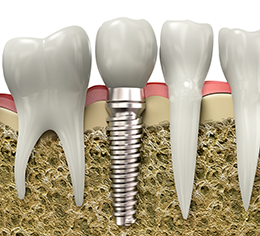Dental Restoration Chicago IL - Dental-implants