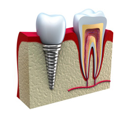 Chicago Dental Implants - Dental Implants