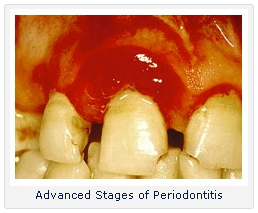 Chicago Dental Care Tips for Diabetics - Advanced stage of periodontitis