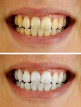 Teeth Whitening Chicago IL - Healthy Teeth
