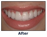 Chicago Porcelian Veneers - After