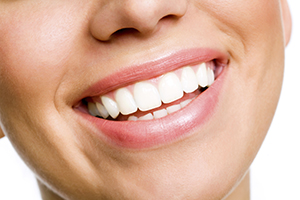 Porcelain Lumineers Chicago - Women Smiling