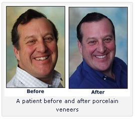 Chicago Porcelian Veneers - Before and After