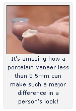 Chicago Porcelian Veneers - Porcelain Veneer