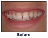 Chicago Porcelian Veneers - Before