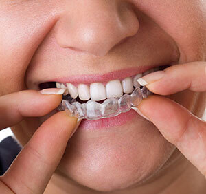A woman wearing invisalign