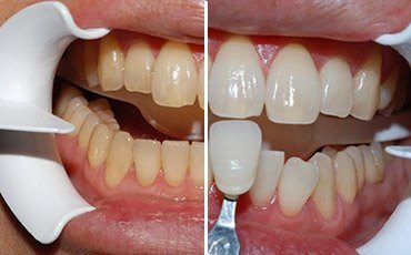 This patient wanted a whiter brighter smile for her wedding.