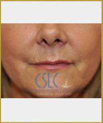 Lip line and corner enhancement