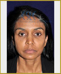 After - Facial Fillers Treatment