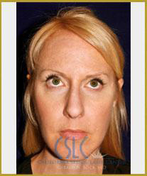 After - Facial Fillers Treatment