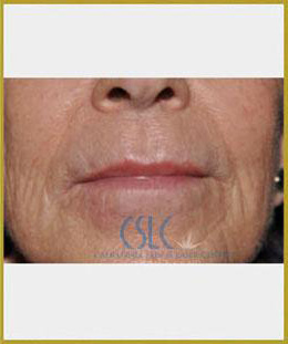 After - Upper Lip Filler Treatment