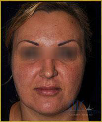 After Fraxel Restore Laser Treatment