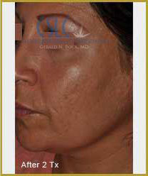 After-Infini Radiofrequency Microneedling