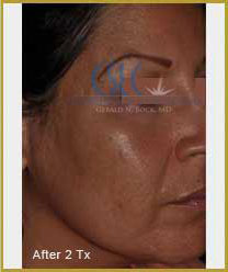 After-Infini Radiofrequency Microneedling
