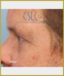 After Infini Radiofrequency Microneedling