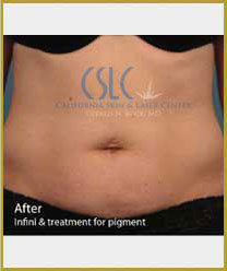 After Infini Radiofrequency Microneedling