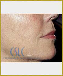 After - Sculptra