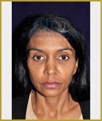 Before - Facial Fillers Treatment