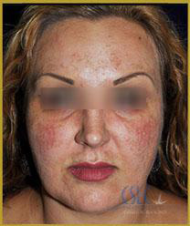 Before Fraxel Restore Laser Treatment