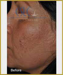 Before-Infini Radiofrequency Microneedling