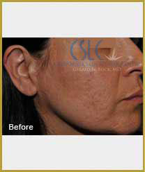 Before-Infini Radiofrequency Microneedling