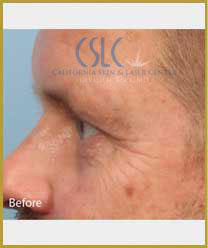 Before Infini Radiofrequency Microneedling