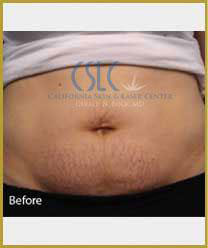 Before Infini Radiofrequency Microneedling