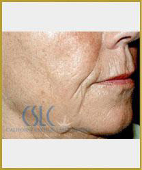 Before - Sculptra