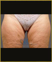 After - CoolSculpting Inner Thighs