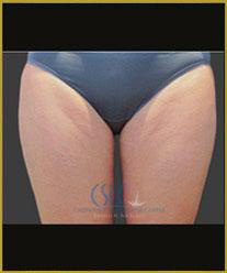 After - CoolSculpting Inner Thighs