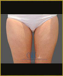 After - CoolSculpting Inner Thighs