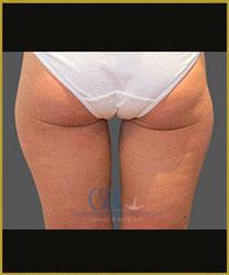 After - CoolSculpting Inner Thighs