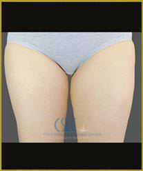 After - CoolSculpting Inner Thighs