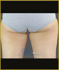 After - CoolSculpting Inner Thighs