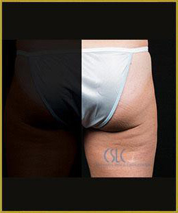 After - CoolSculpting Outer Thighs