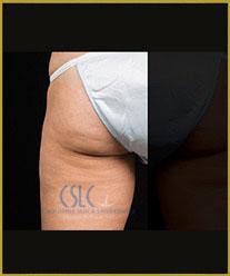 After - CoolSculpting Outer Thighs