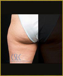After - CoolSculpting Outer Thighs