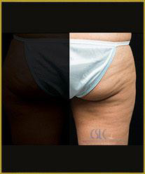 After - CoolSculpting Outer Thighs
