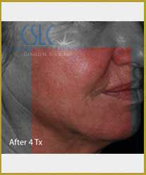 After-Infini Radiofrequency Microneedling