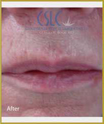 After-Infini Radiofrequency Microneedling